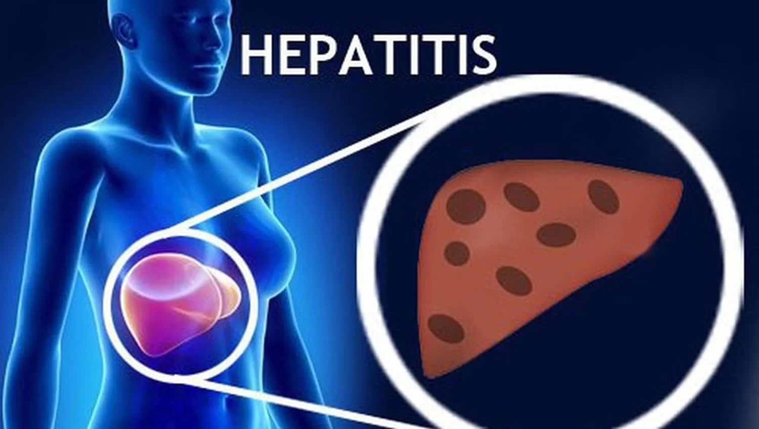 Hepatit C Bulaşma Yöntemleri Ve Risk Faktörleri