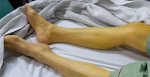 Sarılık Belirtileri Nedir, Nedenleri Nelerdir, Tedavisi Nasıl Yapılır