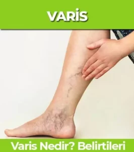 Varis Nedir? Varis Neden Oluşur, Belirtileri Nelerdir?