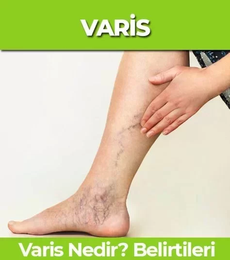 Varis Nedir? Varis Neden Oluşur, Belirtileri Nelerdir?