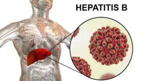 Hepatit B Nedir, Nasıl Bulaşır, Belirtileri Nelerdir